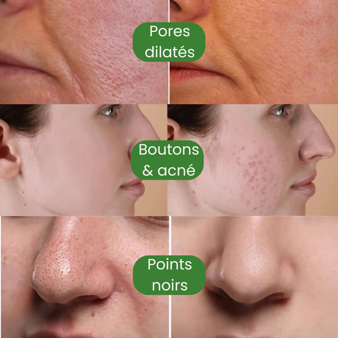 Masque nettoyant anti-points noirs